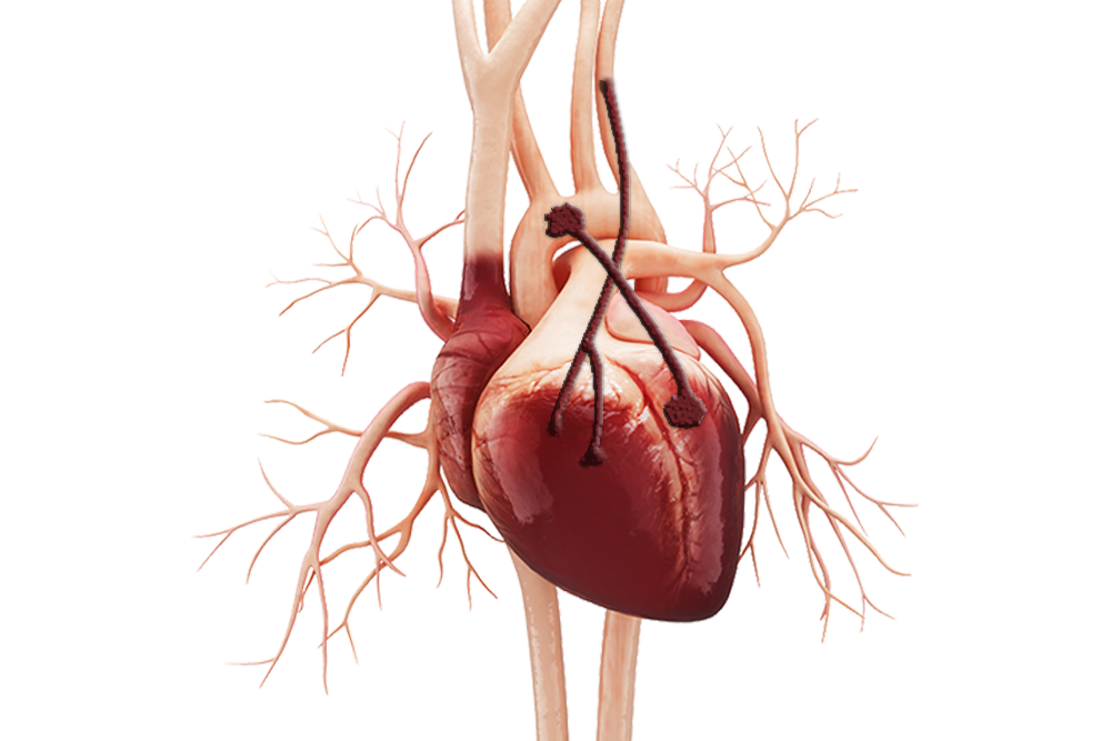 coronary-artery-bypass_01
