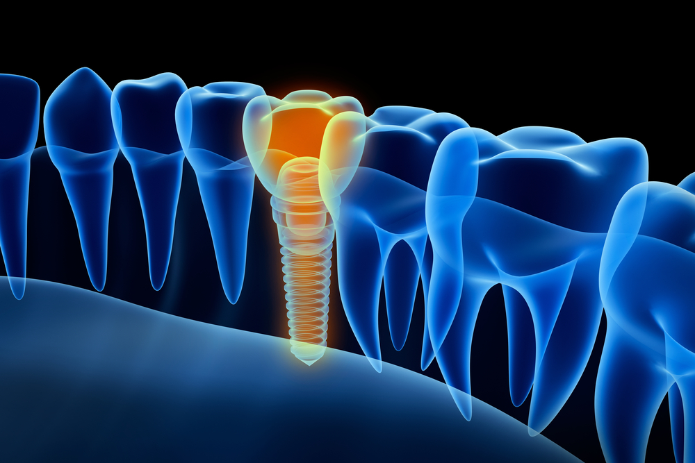 dental-implants