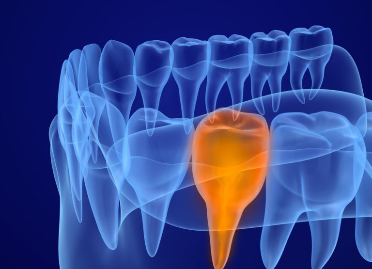 Drainage (Dental) GlobeHealer