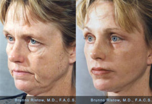 Face_Lift_01_Dr._Ristow