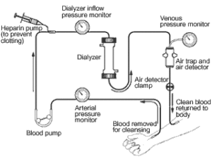 Hemodialysis_schematic