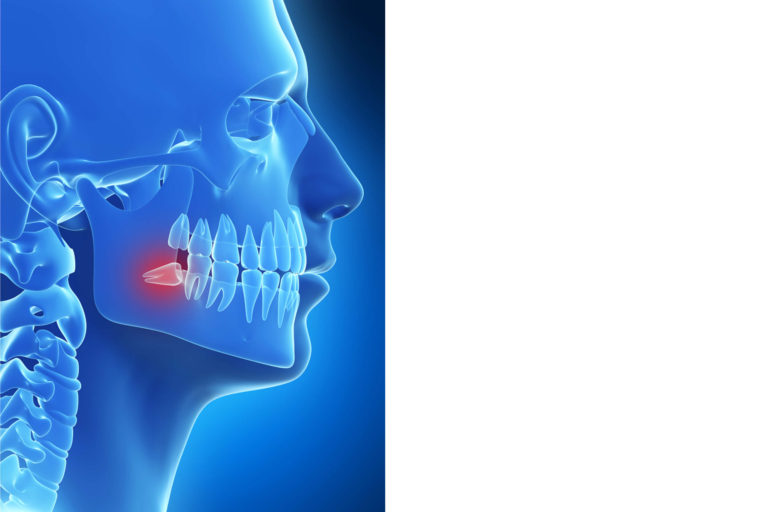 Impaction GlobeHealer