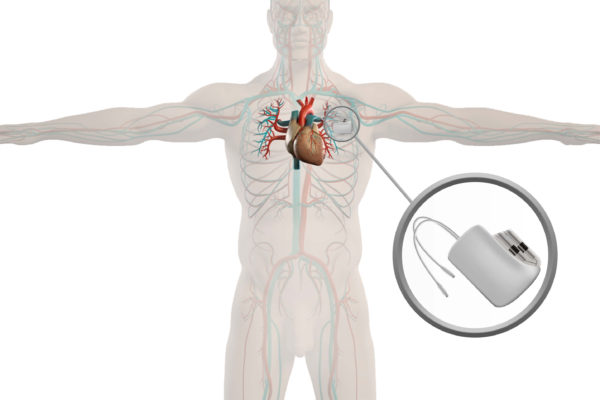 Pacemaker Placement GlobeHealer pacemaker-placement-globehealer