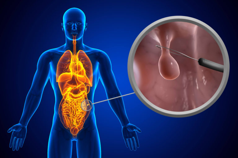 Polypectomy GlobeHealer