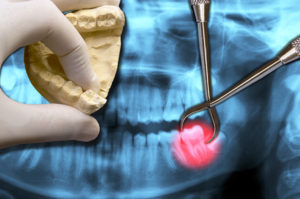 tooth-extraction