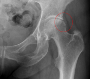 Femoroacetabulares_Impingement_-_67jw_-_Roe_ap_-_001