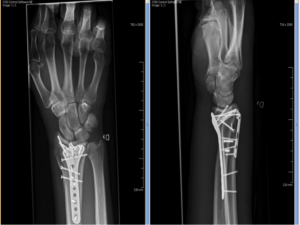 wristfracturesurgery