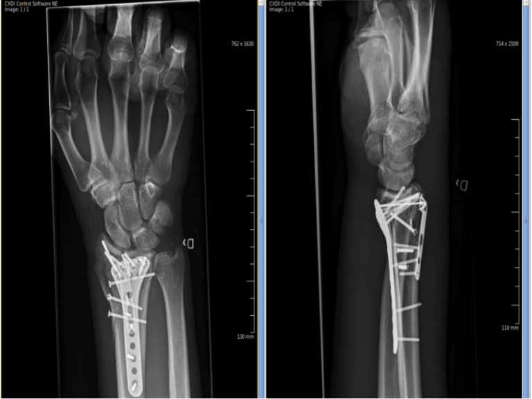 Wrist Fracture Surgery GlobeHealer