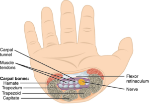 carpaltunnel