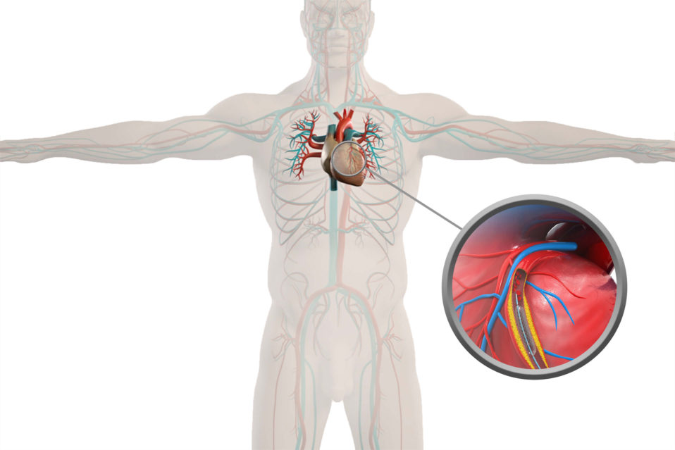 Coronary Artery Stent Placement GlobeHealer