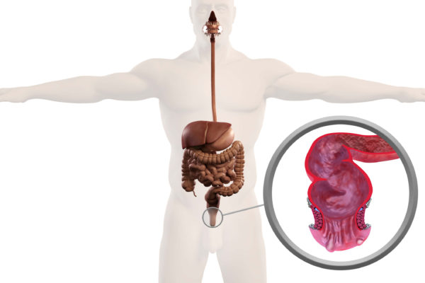 What To Eat After Hemorrhoidectomy Surgery What To Eat After Hemorrhoidectomy Surgery