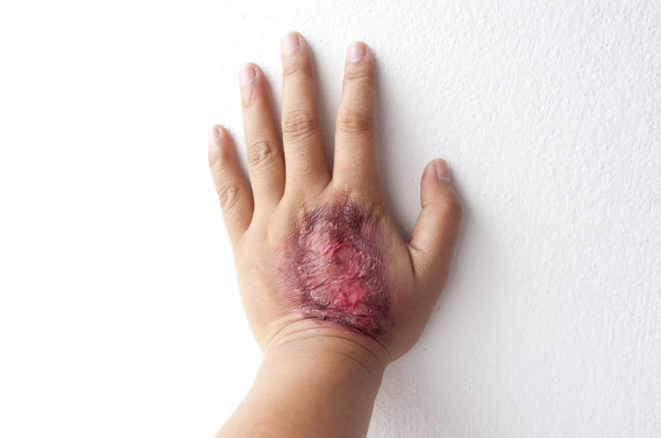 Reconstructive Surgery PostBurn GlobeHealer